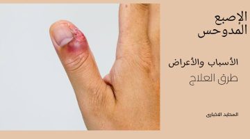 الإصبع المدوحس.. أسبابه وأعراضه وطرق علاجه