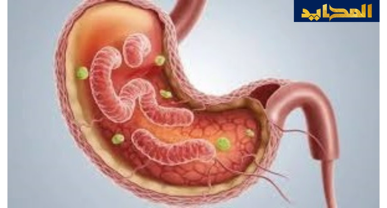 جرثومة المعدة (H. pylori): الأسباب، الأعراض، و3 طرق العلاج النهائي