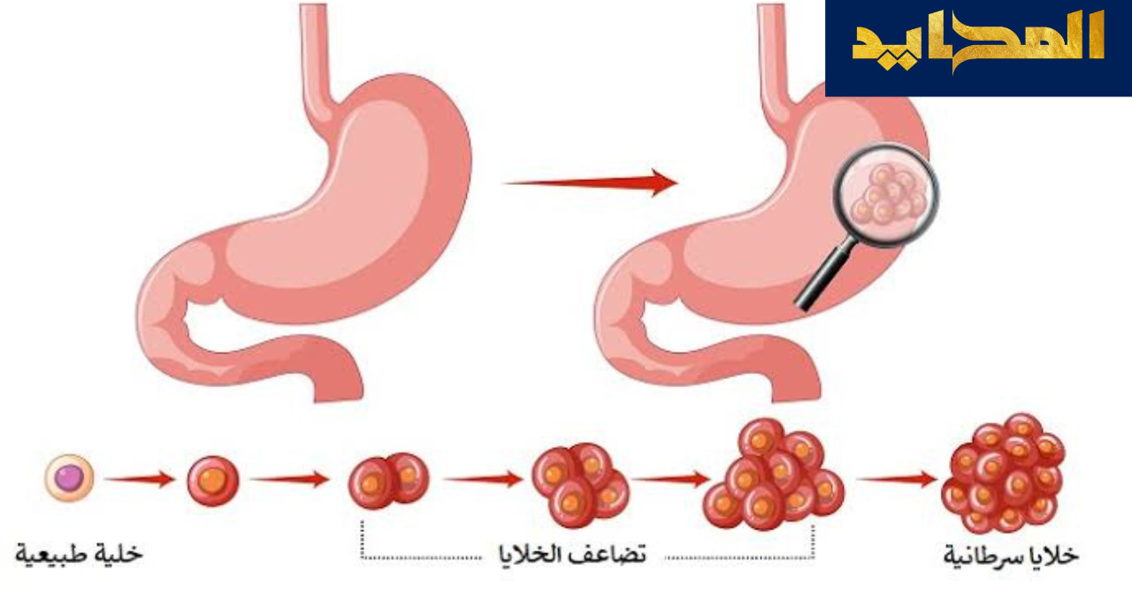 سرطان المعدة.. القاتل الصامت في الجهاز الهضمي