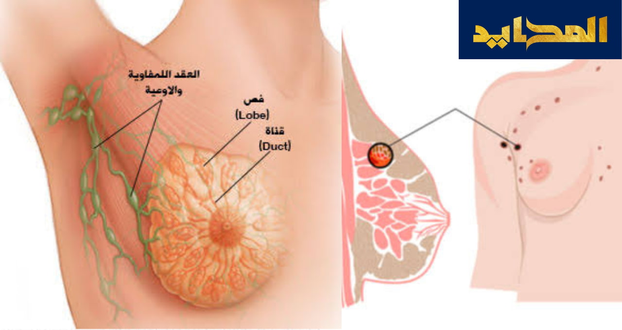 سرطان الثدي “Breast cancer”.. ناقوس خطر يهدد كل سيدة