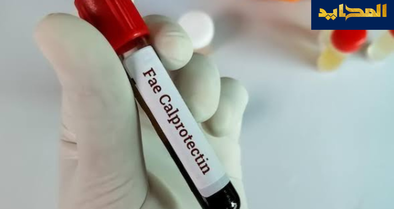 تحليل Fecal calprotectin.. الفحص الحديث لمراقبة التهاب الأمعاء