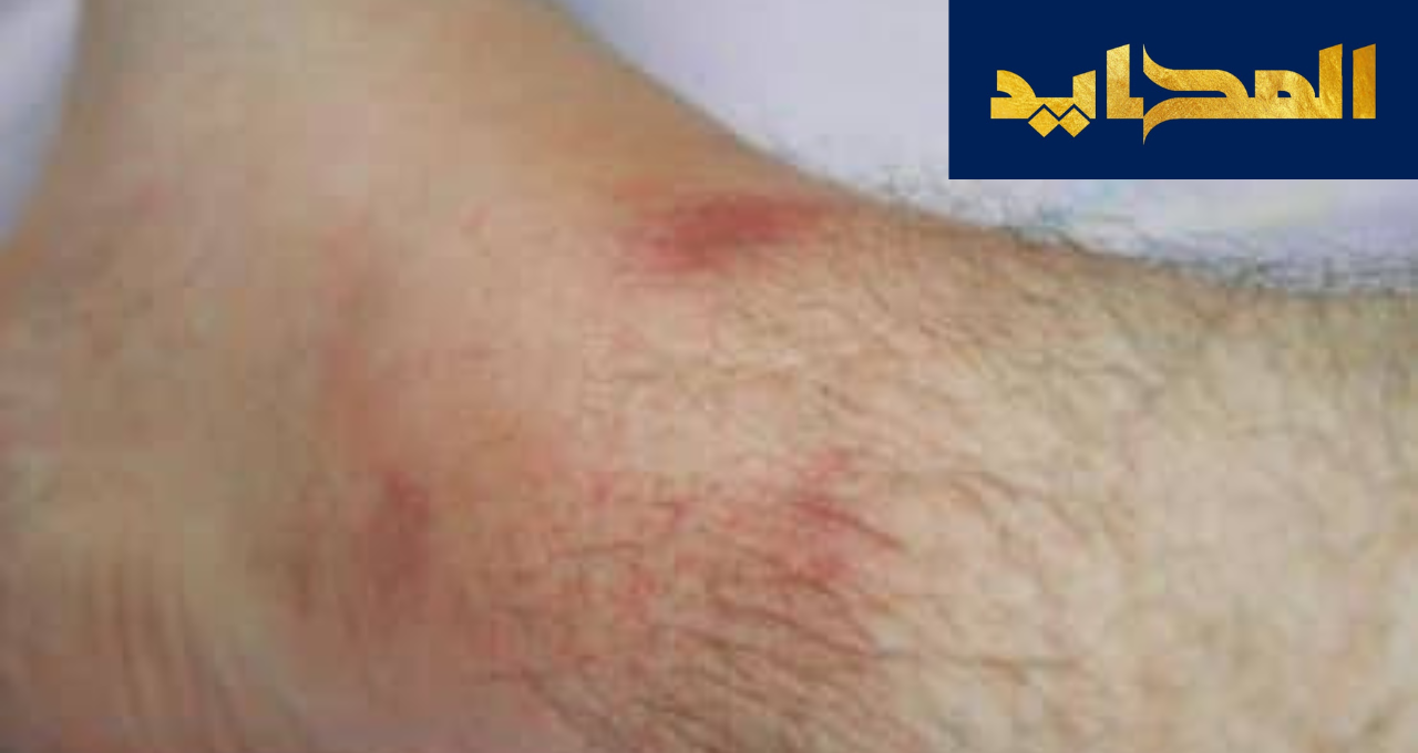 حمى البحر المتوسط.. العدو الوراثي الغامض